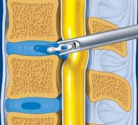 Ablation-hernie-microchirurgie Ablation-hernie-microchirurgie