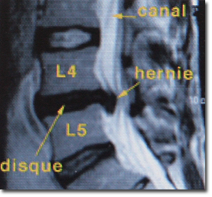hernie-discale-lombaire-responsable-sciatique hernie-discale-lombaire-responsable-sciatique